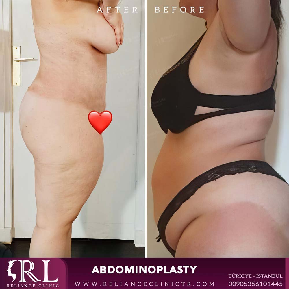 Abdominoplasty