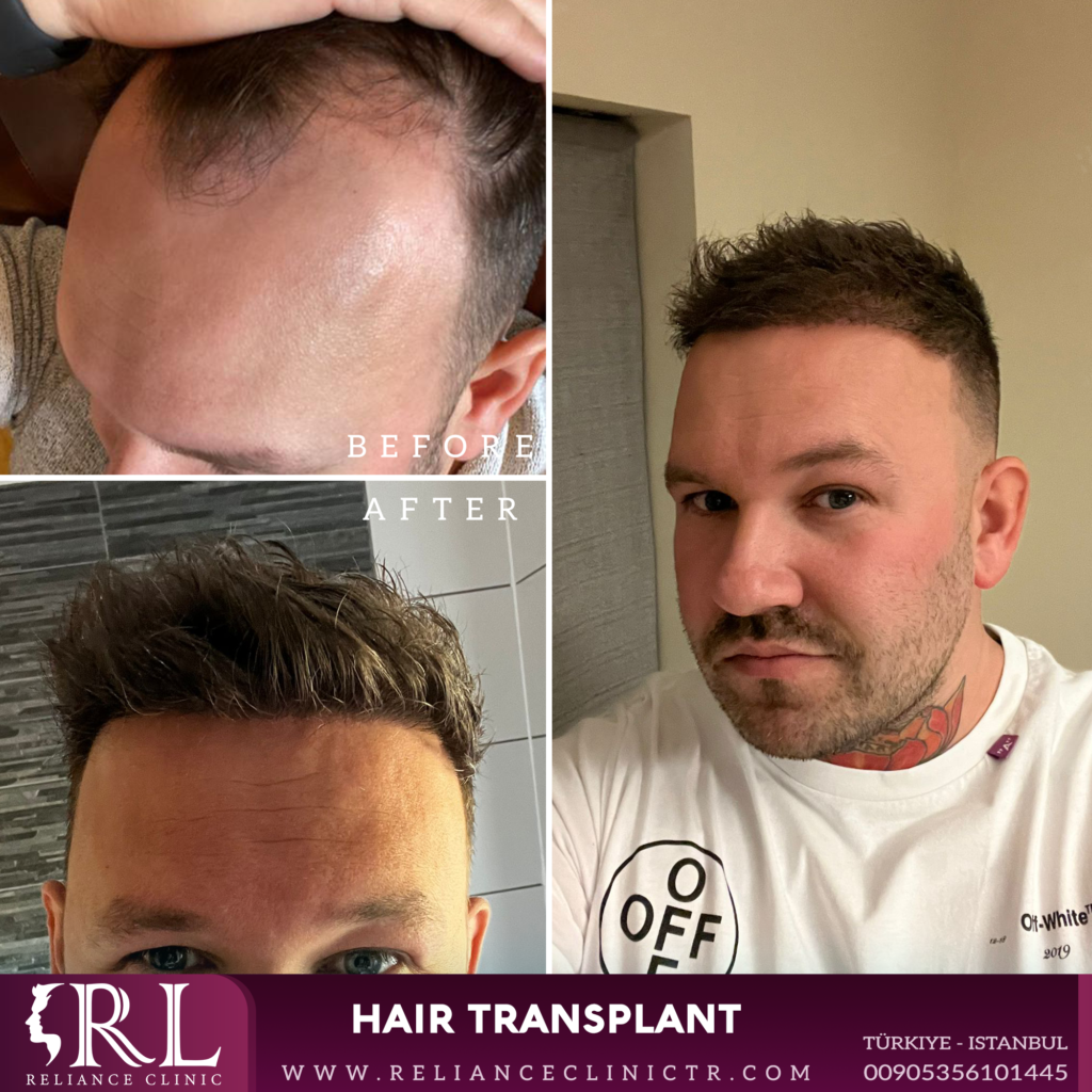 Hair Transplant 31