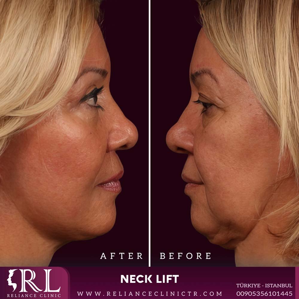 Neck Lift