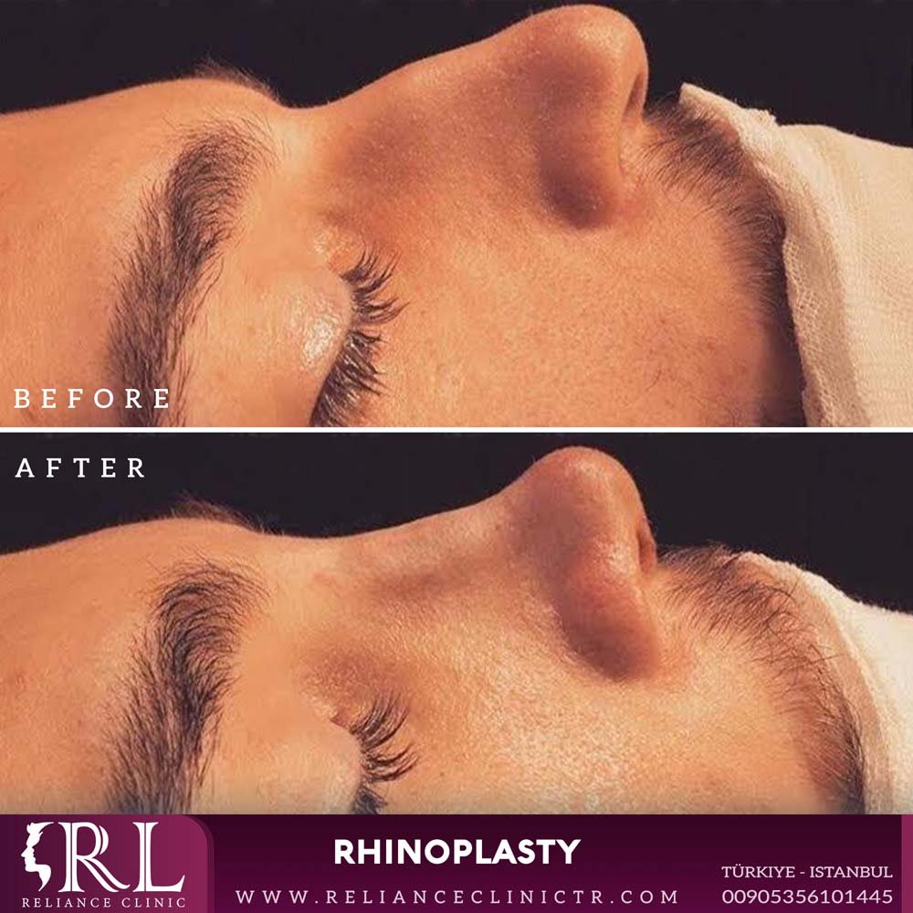 Rhinoplasty 2