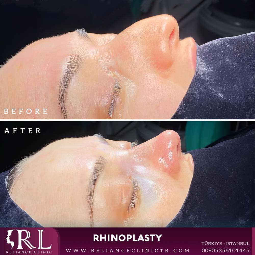 Rhinoplasty 23