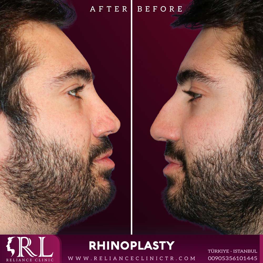 Rhinoplasty 233