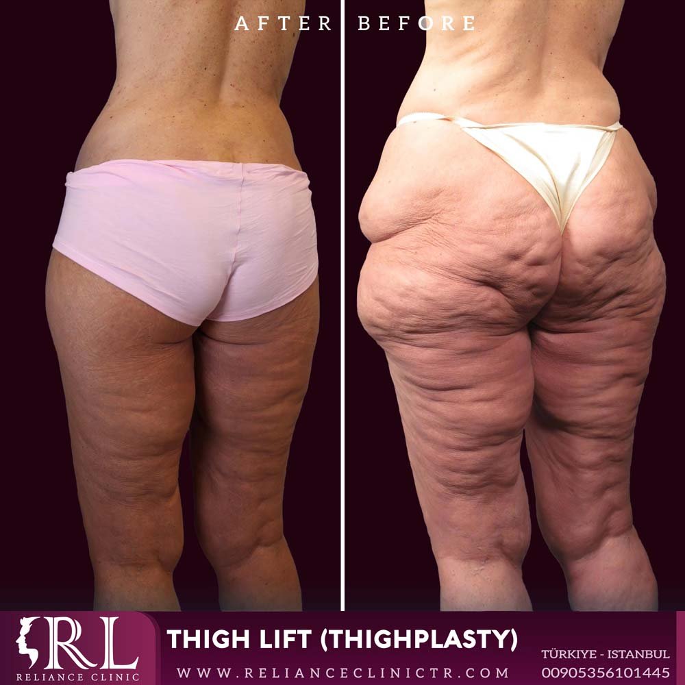 Thigh Lift (Thighplasty)