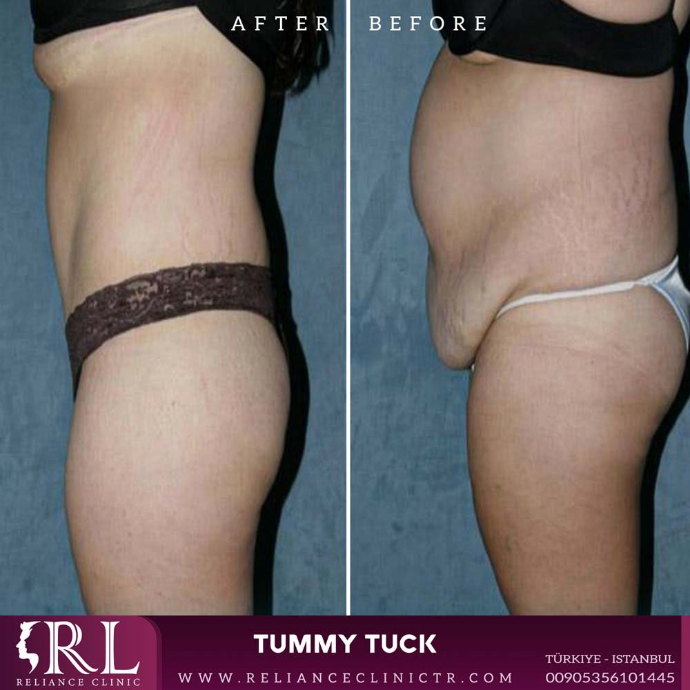 Tummy Tuck 2