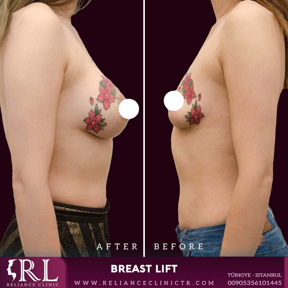 breast lift