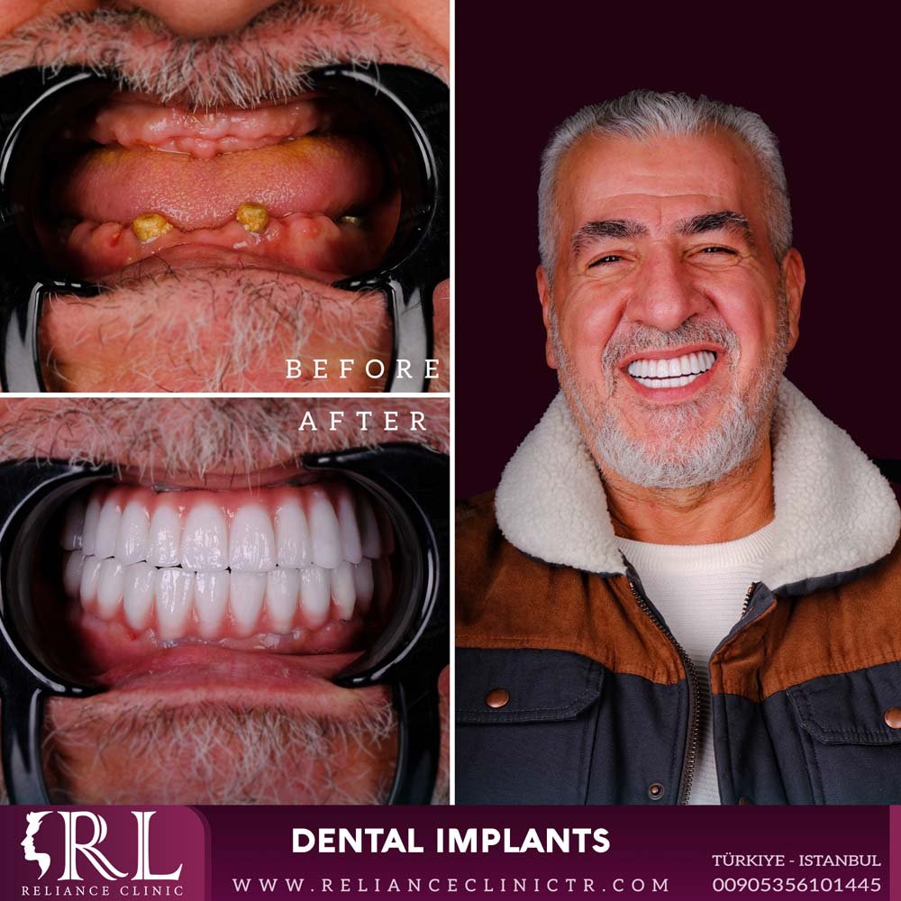 dental implants 2