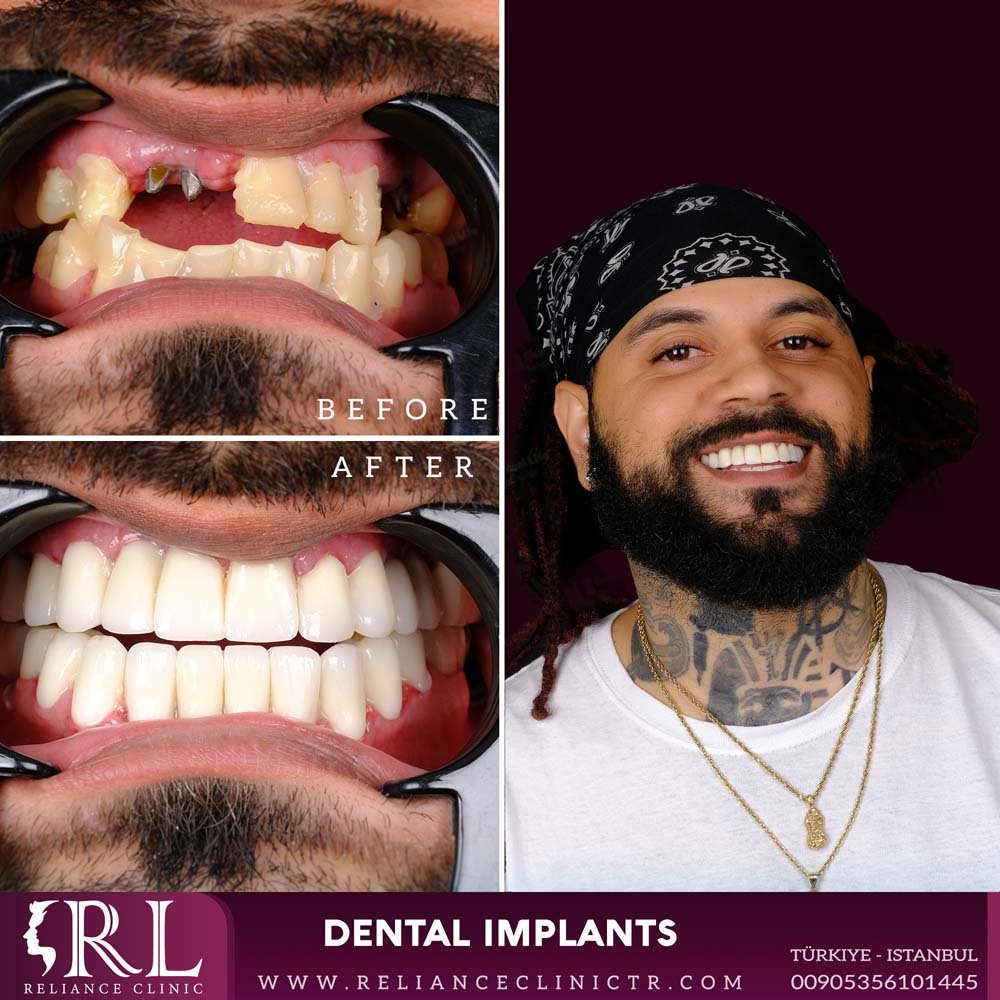 dental implants 21