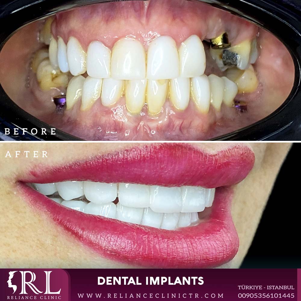 dental implants2