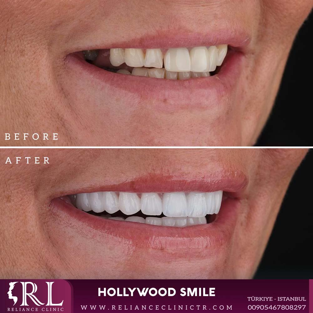 hollywood smile 131