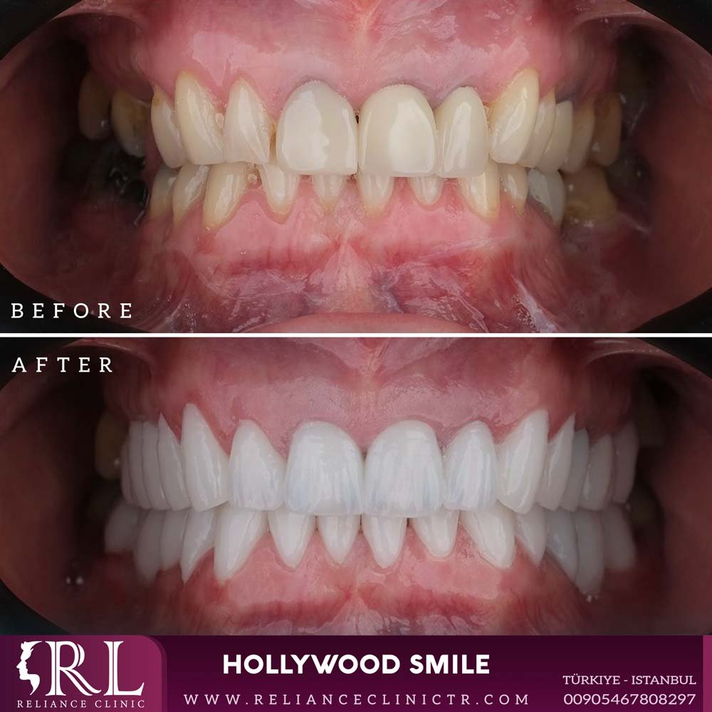 hollywood smile 132