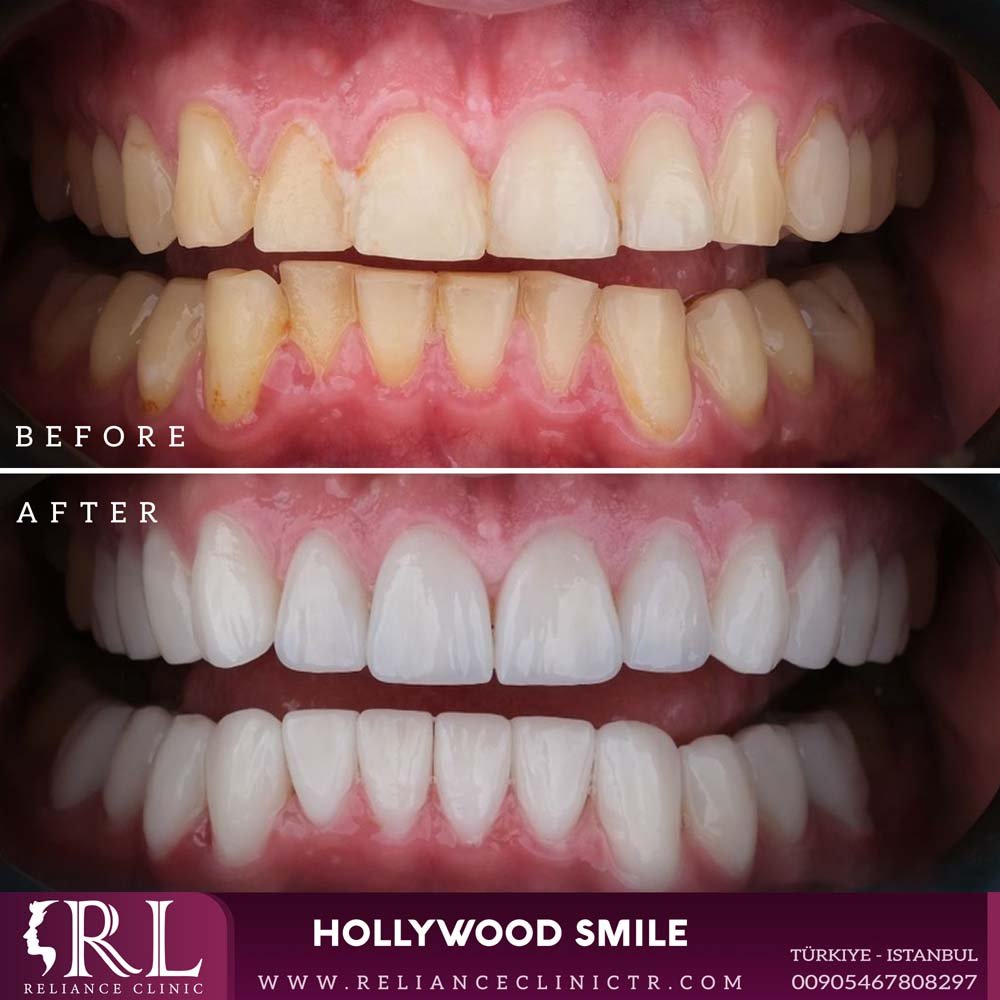 hollywood smile 13261