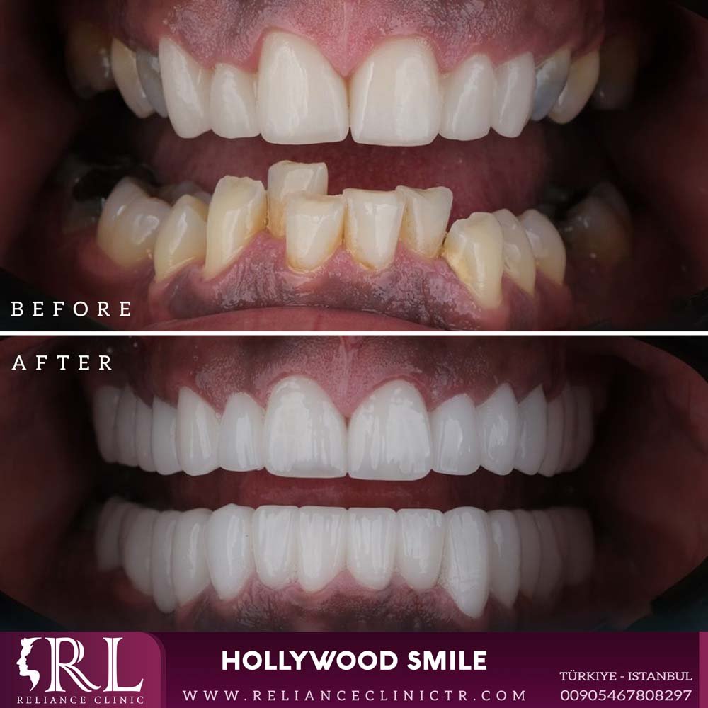 hollywood smile 19