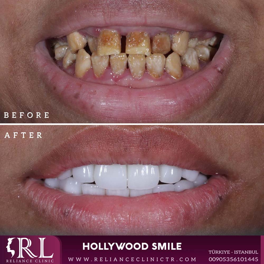 hollywood smile 2