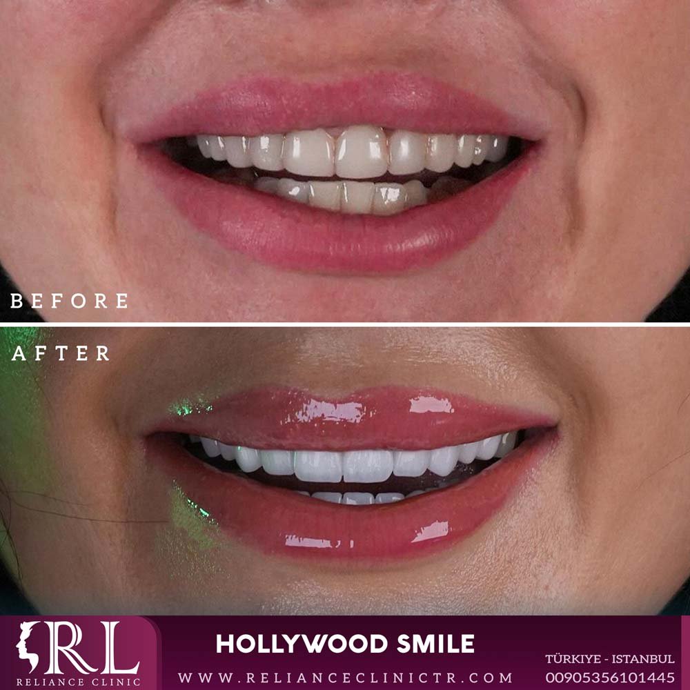 hollywood smile 293