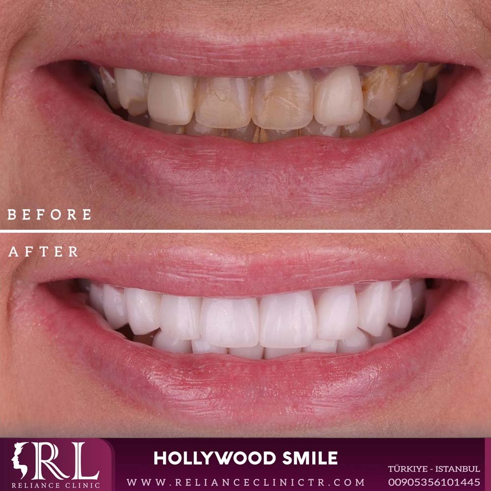 hollywood smile 312