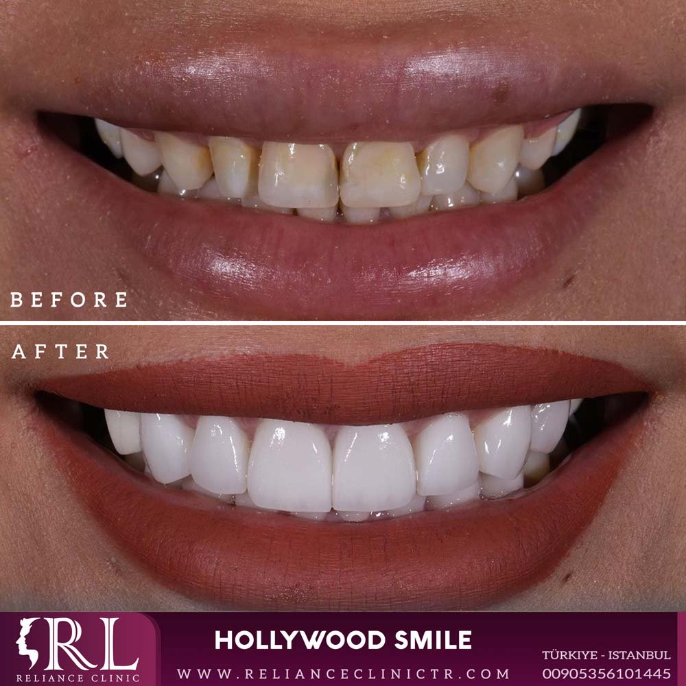 hollywood smile 3129