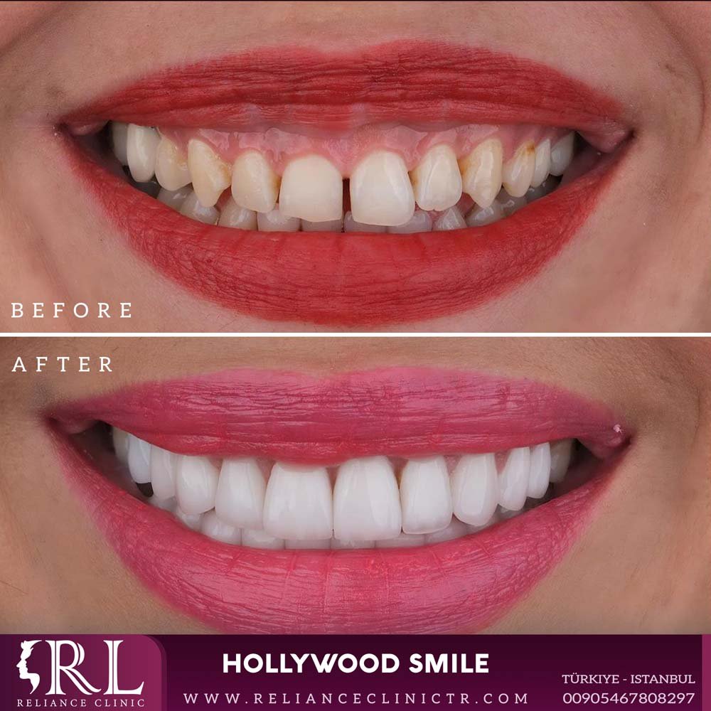 hollywood smile 51