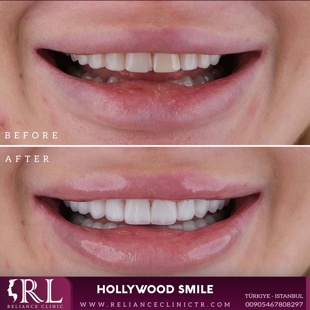 hollywood smile 63