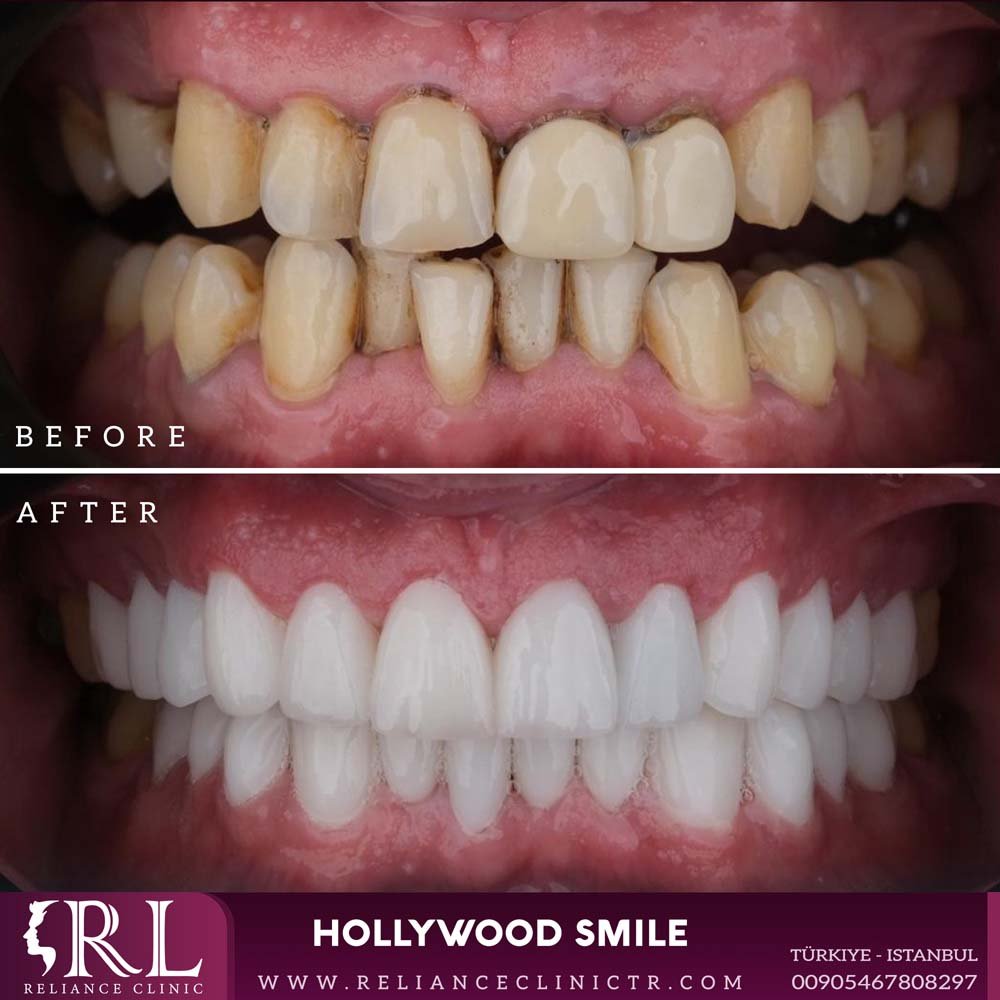 hollywood smile 66