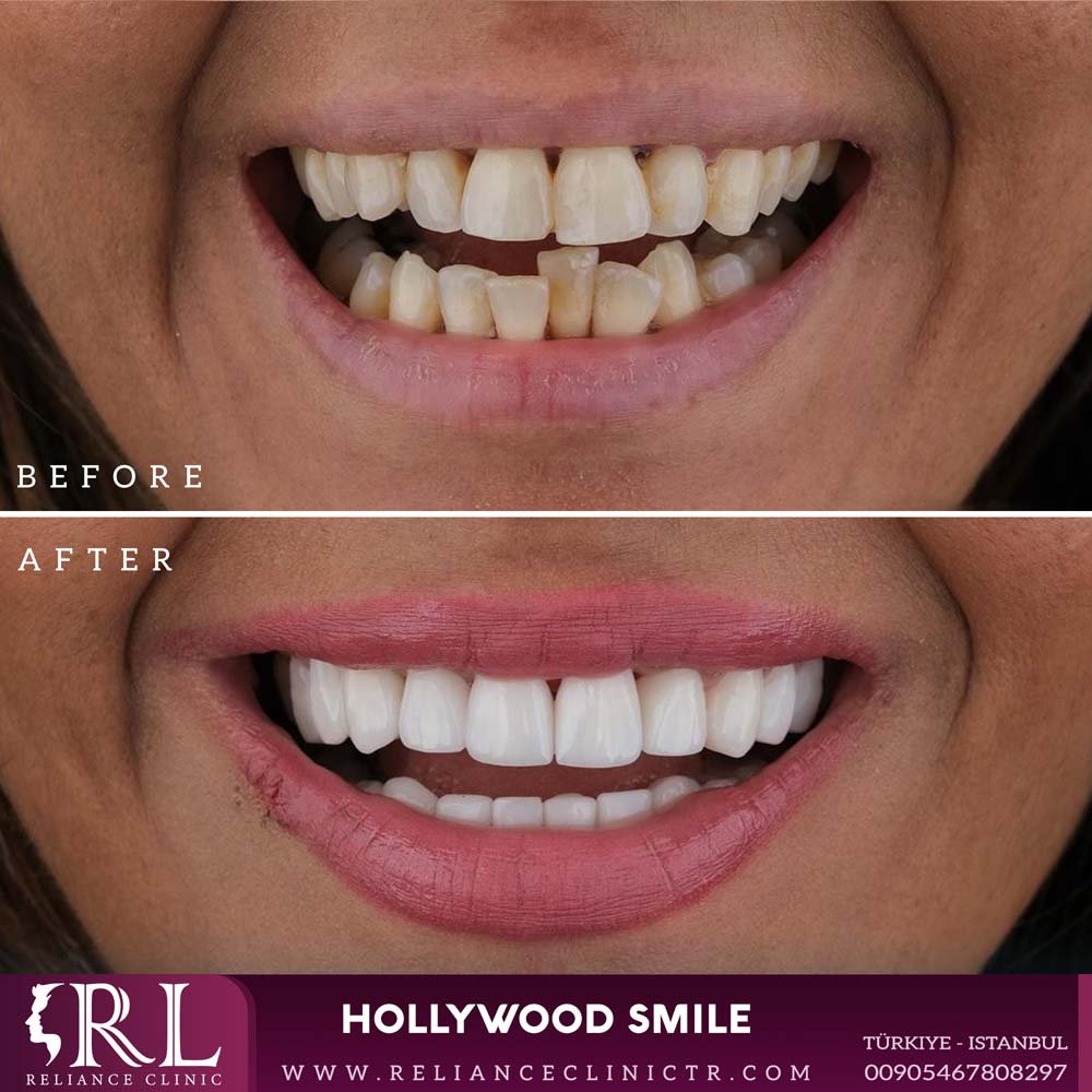 hollywood smile 71