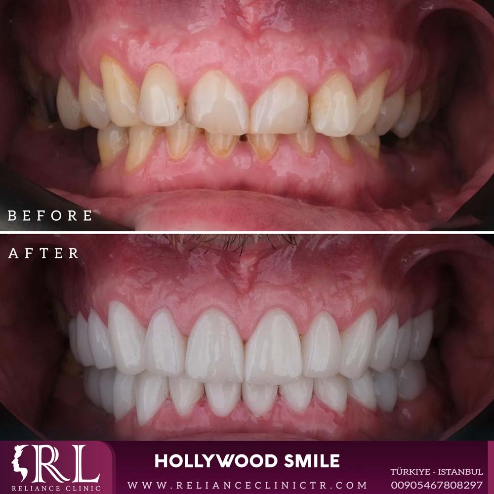 hollywood smile 7312