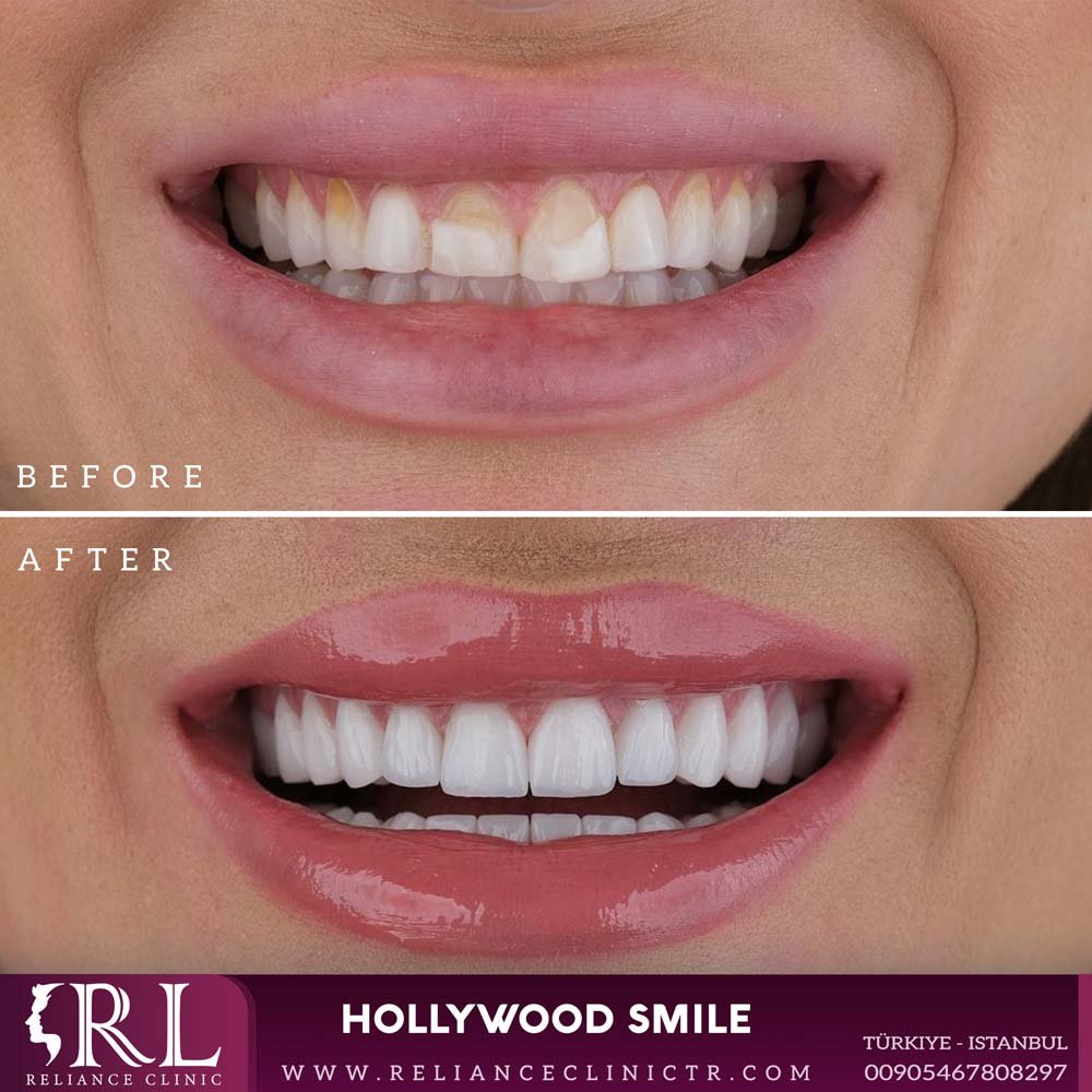 hollywood smile 8