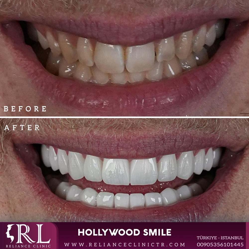 hollywood smile 97