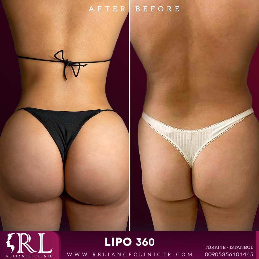 lipo 360 1