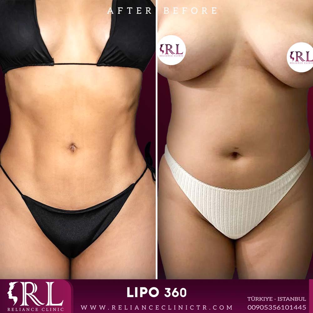 lipo 360 2