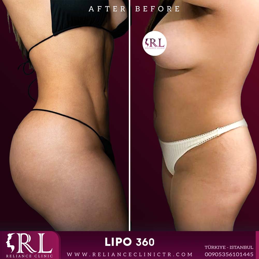 lipo 360 3