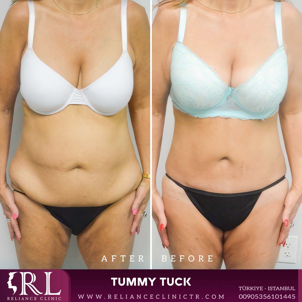 tummy tuck1