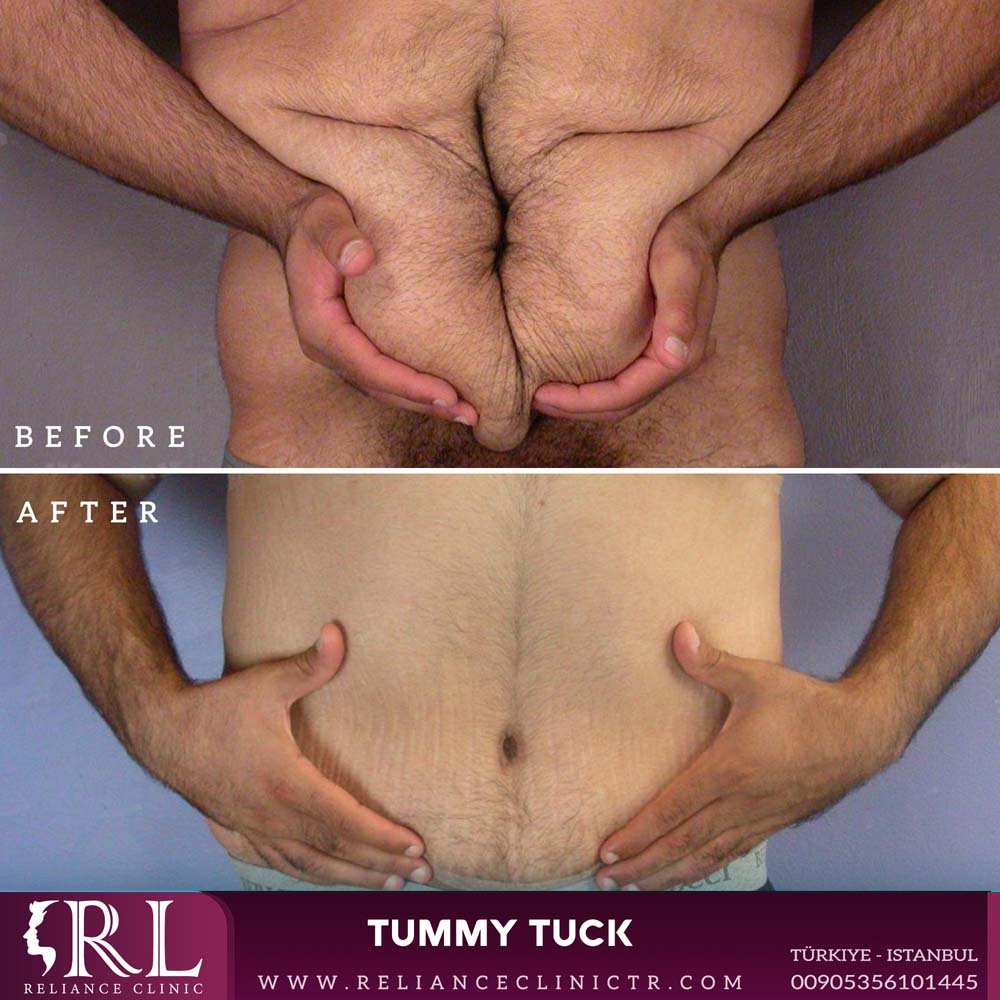 tummy tuck3